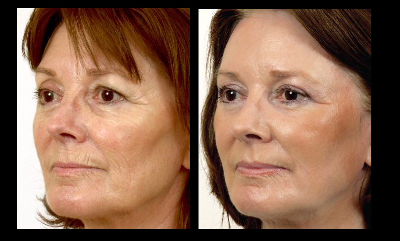 Sciton_Contour_TRL_treatment_Plymouth_Meeting