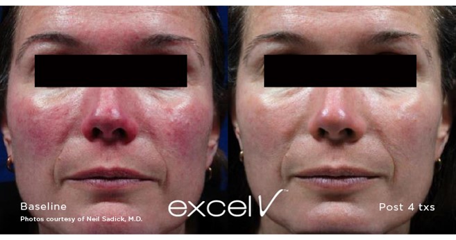 excelV-rosacea