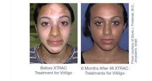 xtrac vitiligo