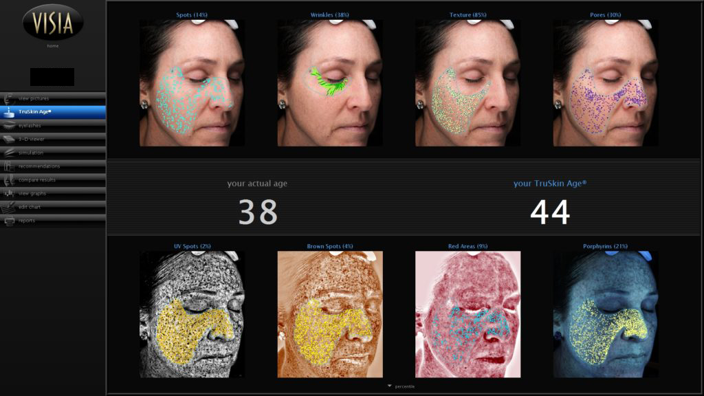 <center>Scan Before Treatment</center>