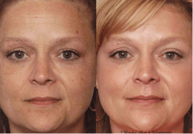ipl photo rejuvenation philadelphia ipl photo rejuvenation philadelphia