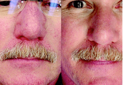 ipl photo rejuvenation plymouth meeting ipl photo rejuvenation plymouth meeting